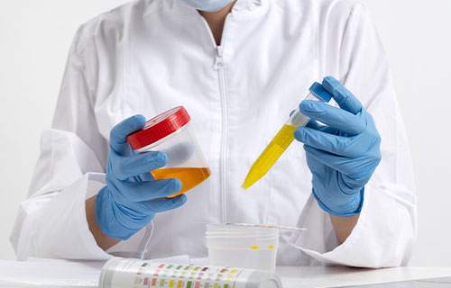 Lipid Profile Tests