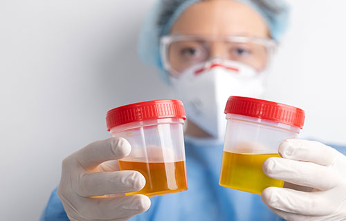 Urine Analysis